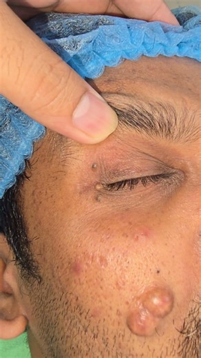 Face cyst