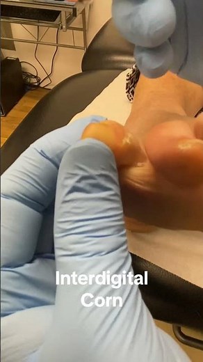 Amazing Foot Transformation Podiatrist Removes Painful Corns & Calluses #FootCare #Podiatry