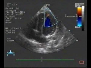 Apical Ventricular Septal Defect  • Video • MEDtube.net