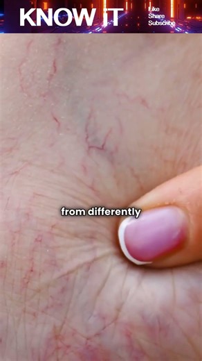 What are Birthmarks?
