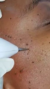 62K views · 369 reactions | SKIN TAGS REMOVAL (Dikakana) What are...