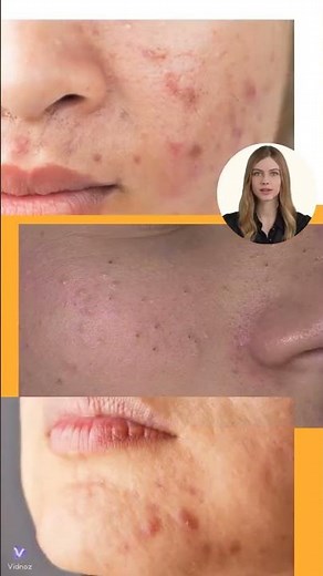Peeling kawitacyjny – co to jest i jakie daje efekty ?