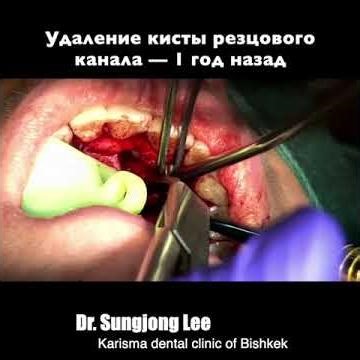 Nasopalatine duck cyst 1 year follow up