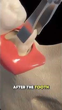 Ever Wondered How Tooth Extraction Procedure Is Done - 3D Animation #ToothExtraction #DentalSurgery