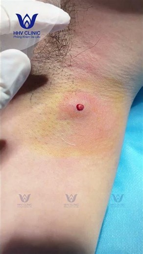 Ca Áp Xe Nách Nặng Với Lượng Mủ Bên Trong Gây Bất Ngờ
