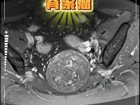 每日影像病例分享（2026.2.25）:脊索瘤