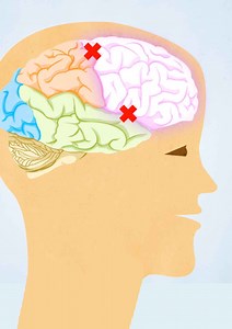 The Role of Medication in ADHD - Flynn Forum