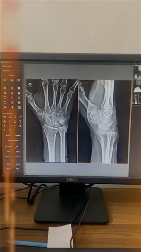 Wrist ap Lat X-Ray 🩻 | tell me what the problem is