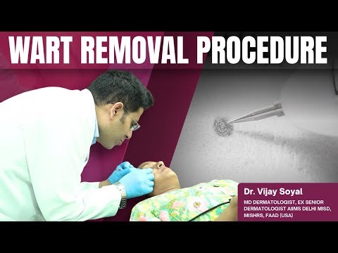 How to Remove Warts | Best Laser Wart Removal Treatment | Causes, Procedure & Results
