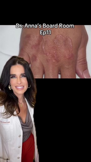 Navigating the nuances of Granuloma Annulare – an enigmatic skin condition characterized by circular, raised plaques. 🔄 Diagnosis and treatment of this condition require a trained eye, otherwise it is often misdiagnosed as another skin condition. Let me know in the comments below what other dermatologic conditions you want me to learn about! #drannasboardroom #boardreview #medicaldermatology #granulomaannulare #drannaguanche