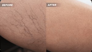 Top Spider Vein Treatments 2025 | Pros and Cons