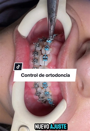 Control de ortodoncia 🥰 #brackets #ortodoncia #sonrisa #maodental #odontologo
