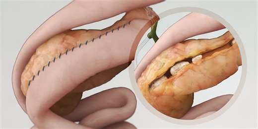 Longitudinal Pancreaticojejunostomy (Puestow Procedure) - TVASurg - The Toronto Video Atlas of Surgery