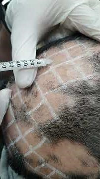 Demo-19: Intralesional triamcinolone for alopecia areata.