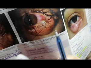 Eyelid | Hordeolum.... Part. 3