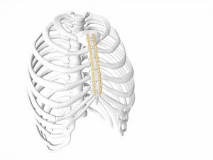 Longitudinal Sternal Stabilization (LSS) by KLS Martin