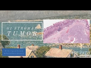 GI Stromal tumor