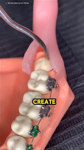 Why the Dentist Had to Remove This Tooth!