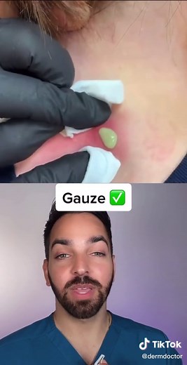 Technique is perfect #dermdoctor #dermatologist #cyst #pimplepopper #learnontiktok #tiktokpartner