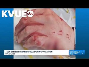 Texas teen bitten by barracuda during vacation