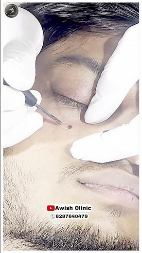 "Say Goodbye to Moles: DIY Removal Techniques" ||Awish Clinic
