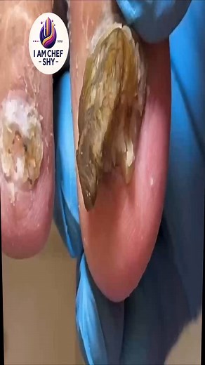 Effective Callused-Toe Support with Gentle Safe Steps 🍡🍎 #FootWellnessDaily #FootSupportGuide #SafeCareSteps | I am Chef Shy