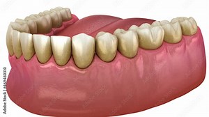 Gum recession process. Medically accurate 3D animation