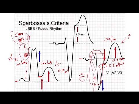 Criterios de Sgarbossa Electro