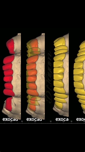 #dental #dentist #digitaldintistry #exocad #dentaldb #dentaldesign #dentaldesigner #exocadexpert #exocadexperts #exocaddental #anteriorteeth #dintistry #articulator #vira #exo #toothbrush #dentistry #teethwhitening #turkish#ليبيا #سوريا