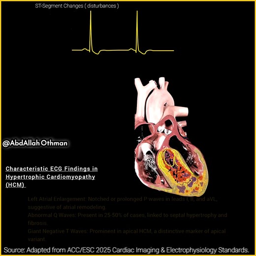 Characteristic ECG Findings in Hypertrophic Cardiomyopathy (HCM) 🔹 LVH: Elevated QRS amplitude in limb/precordial leads, signaling increased myocardial mass. 🔹 Q Waves: Deep, narrow Qs in II, III, aVF, I, aVL, V5-V6, mimicking MI due to septal hypertrophy. 🔹 ST-T Changes: Depression & T-wave inversion in lateral leads, hinting at repolarization issues. 🔹 Left Atrial Enlargement: Notched/prolonged P waves in I, II, aVL, showing atrial remodeling. 🔹 Abnormal Q Waves: 25-50% of cases, tied to 
