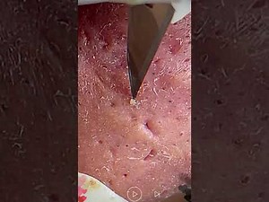 Skincare | Blackheads Removal #851 #tweezers skincare #blackheads blackheads