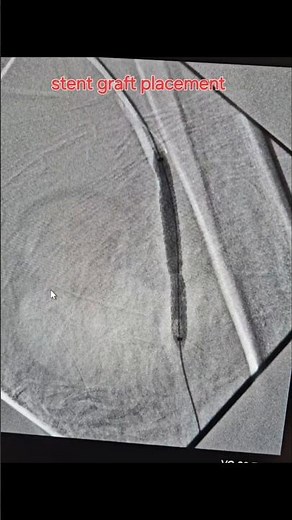 Covered stent graft placement for post traumatic pseudoaneurysm of superficial femoral artery (SFA)