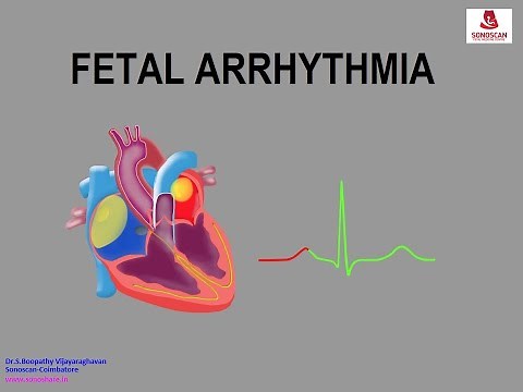 Fetal Echocardiography - Fetal Arrhythmia