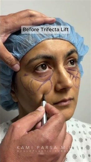 She was Tired of Her Eye Bags, So She Saw Dr. Parsa for Trifecta Lift
