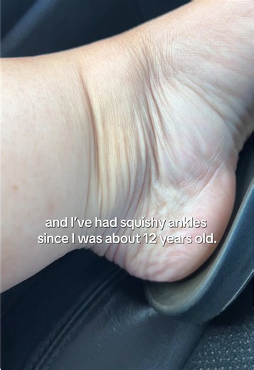 One of the signs of my lipedema has always been these soft fat pads around my ankles. I’ve had them for as long as I can remember—probably since around age 12. Even at my lowest adult weight (around 130 pounds), they never went away. Lipedema fat is resistant to diet and exercise and often develops around times of hormonal change, such as puberty. People often ask if this is lymphedema. Lymphedema usually develops later in life and often affects one side more than the other. In my case, these so