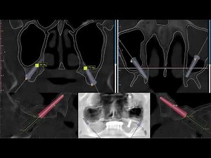 Guided Pterygoid Implant for Severely Atrophic Maxilla