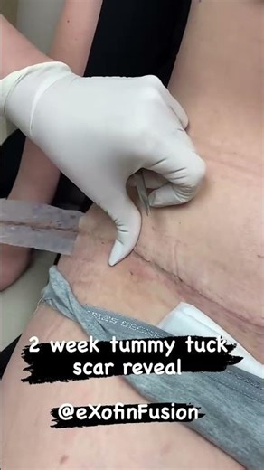 Tummy tuck scar reveal at 2 weeks.
