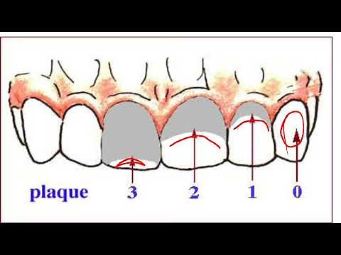 PLAQUE INDEX//#FABDENTIST//