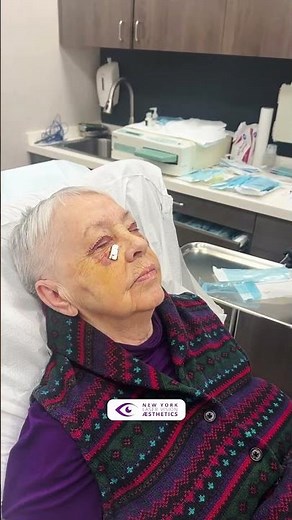 Blepharoplasty Recovery Journey with New York Laser Vision