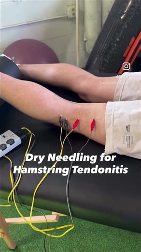 Hamstring Dry Needling