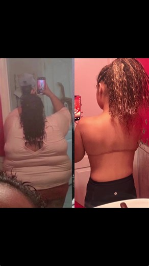 one year post op - upper bra line back lift & extended bracioplasty ✨ forever happy with my results & so thankful i chose to do it. feeling free in my own body is the best feeling #beforeandafter #looseskin #weightlossmotivation #weightloss #bodypositivity