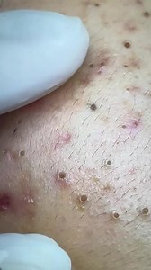 Pimples galore on TikTok