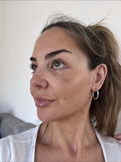 Exactly 1 week since my lower Bleph surgery. Stitches were removed today. Still bruised and slightly swollen but getting better day by day. #lowerbleph #eyebags #eyelidsurgrey #lowerblepharoplsty #surgeryupdates #plasticsurgery #surgeryuk
