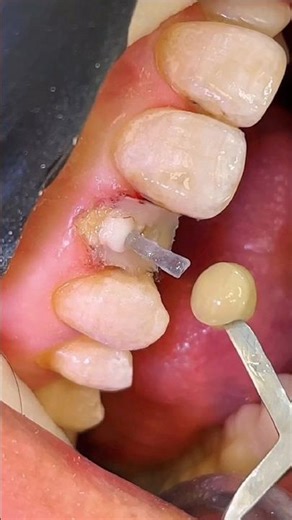 🔥 Broken Root ➜ Perfect Tooth 💫 | Part 3: Tooth Rebuild Composite Magic 🦷✨