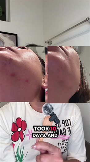 Post-holiday skin reset ✨ Sharing what worked for me. @Dr.Leo-USA #salicylicacid #drleodryinglotion #acne #skincareroutine #TikTokShopHolidayHaul