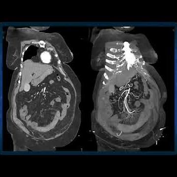 Small Bowel Enteritis due to ACE Inhibitors (Lisinopril)