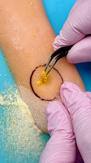 1.3M views · 2.5K reactions | Core Callus Treatment!  | 5-Minute Crafts | Facebook