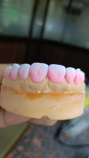 Emax veneers | Shahanamaj Alam