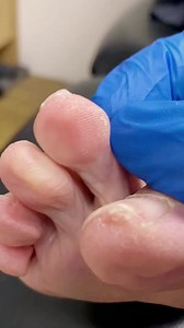8.3K views · 32 reactions | Revealing secrets of hard callus removal! Watch and say goodbye to toe woes.禮. . . #footpain #plantarfasciitis #heelpain #podiatry #footcare #podiatrist #orthotics #feet #foothealth #kneepain #foot #running #anklepain #backpain #bunions #flatfeet #healthyfeet #footpainrelief #arthritis #health #footdoctor #bunion #fyp #foryou #viralreels #explorereels | Docpods Treatment | Facebook