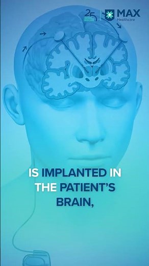 Deep Brain Stimulation: A New Hope for Parkinson’s and Dystonia